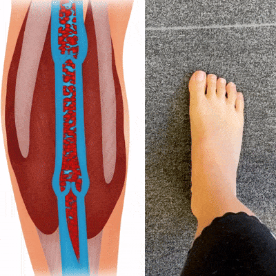 CryoSole™ Plantar Fasciitis Sleeve - Instant Relief in just 5 minutes*